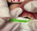Çocuklara Florür Uygulaması Zararlı Mı?